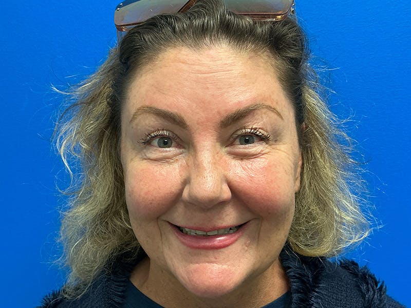 Botox Xeomin Before & After Gallery - Patient 925350 - Image 4