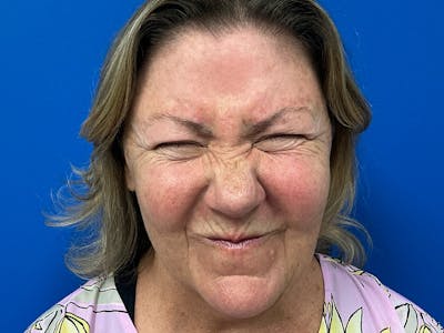 Botox Xeomin Before & After Gallery - Patient 925350 - Image 1
