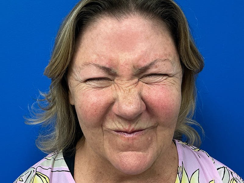 Botox Xeomin Before & After Gallery - Patient 925350 - Image 1