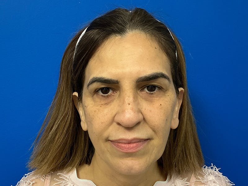 Facial Fillers Before & After Gallery - Patient 368027 - Image 3