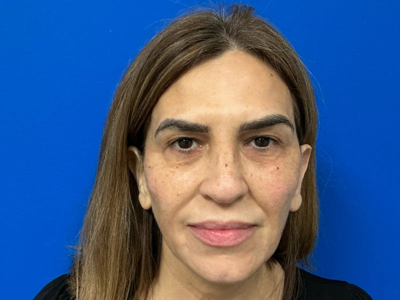 Facial Fillers Before & After Gallery - Patient 368027 - Image 4