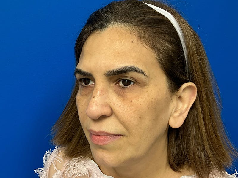 Facial Fillers Before & After Gallery - Patient 368027 - Image 1