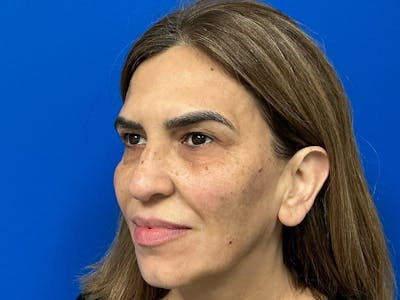 Facial Fillers Before & After Gallery - Patient 368027 - Image 2