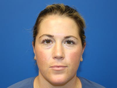 Dermaplaning Before & After Gallery - Patient 622074 - Image 1