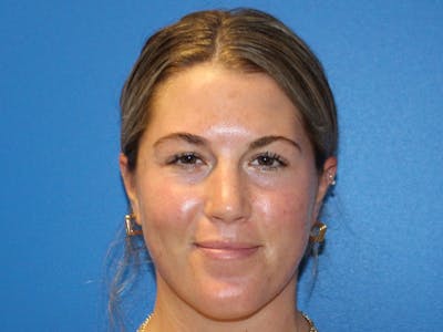 Dermaplaning Before & After Gallery - Patient 622074 - Image 2