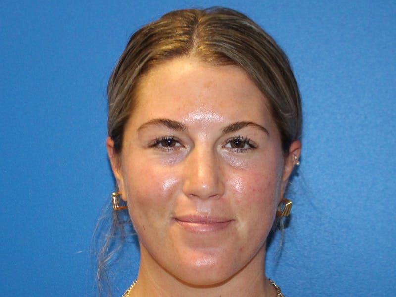 Dermaplaning Before & After Gallery - Patient 622074 - Image 2
