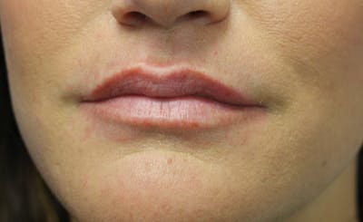 Facial Fillers Before & After Gallery - Patient 143365 - Image 1
