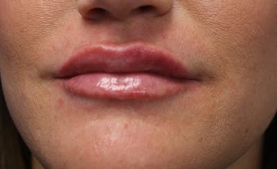 Facial Fillers Before & After Gallery - Patient 143365 - Image 2