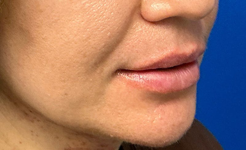 Facial Fillers Before & After Gallery - Patient 562026 - Image 3