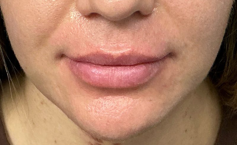 Facial Fillers Before & After Gallery - Patient 562026 - Image 1