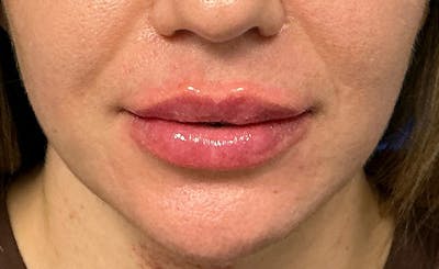 Facial Fillers Before & After Gallery - Patient 562026 - Image 2