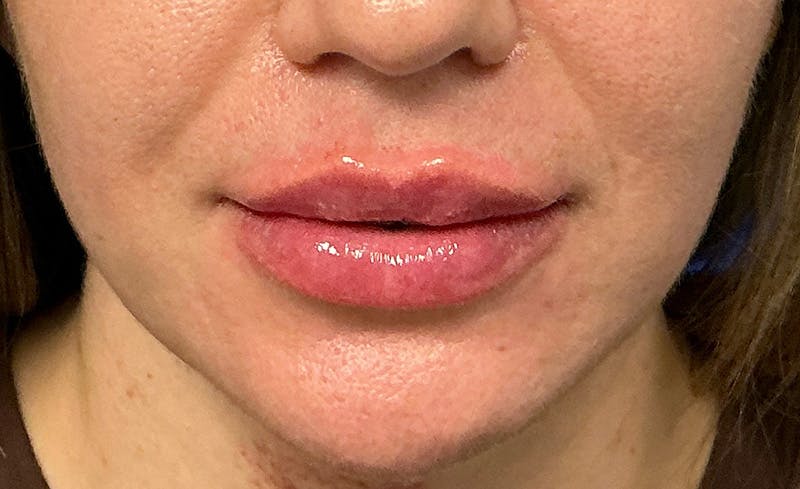 Facial Fillers Before & After Gallery - Patient 562026 - Image 2