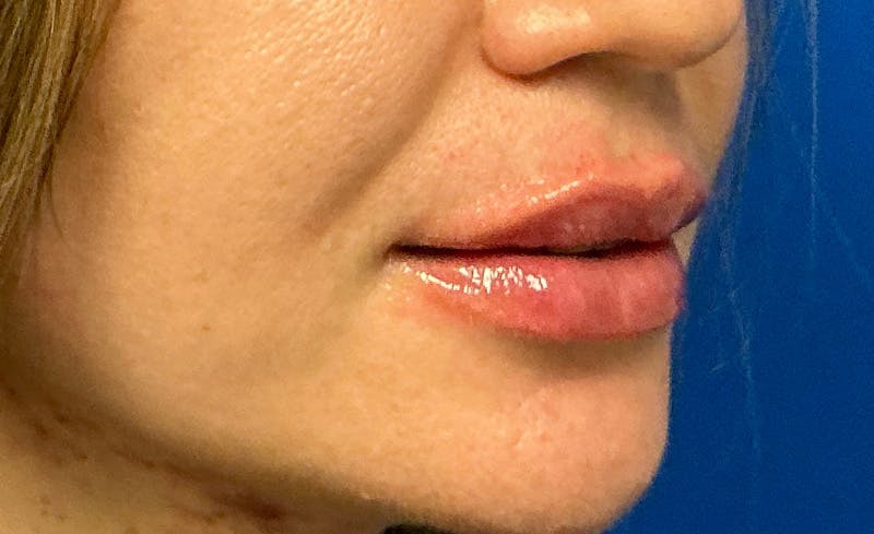 Facial Fillers Before & After Gallery - Patient 562026 - Image 4