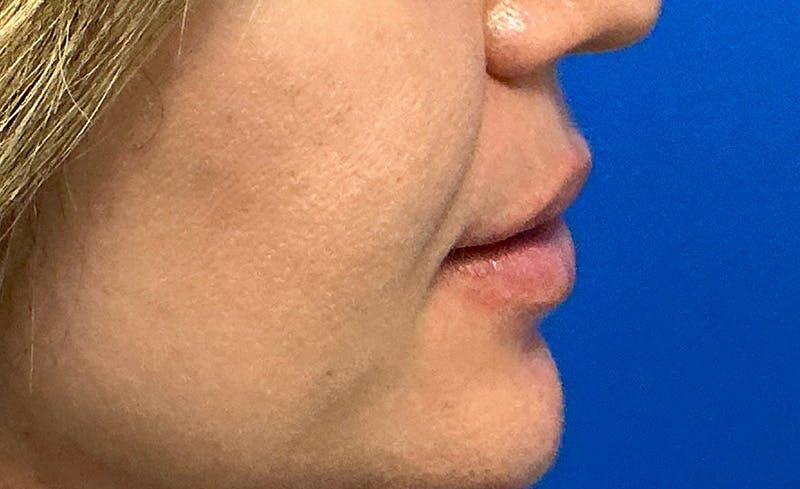 Facial Fillers Before & After Gallery - Patient 562026 - Image 5