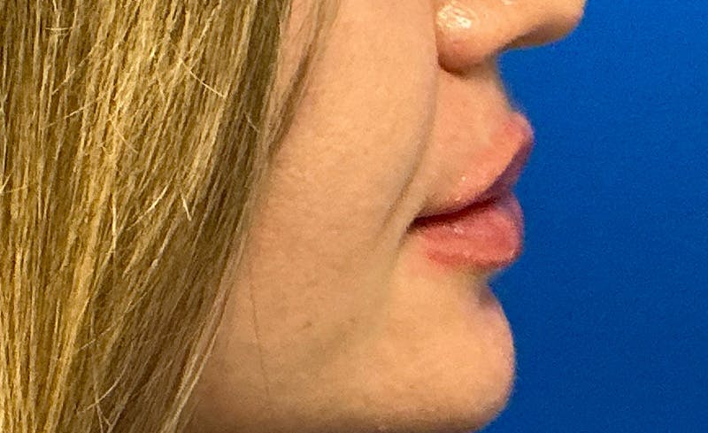 Facial Fillers Before & After Gallery - Patient 562026 - Image 6