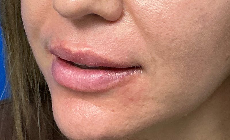 Facial Fillers Before & After Gallery - Patient 562026 - Image 7