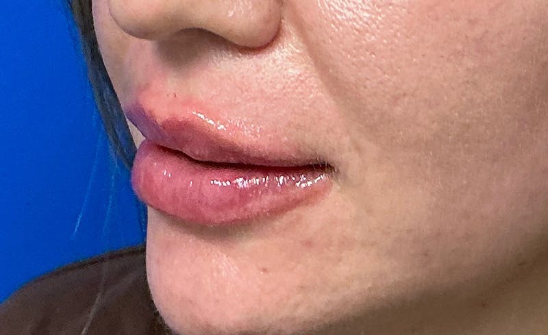 Facial Fillers Before & After Gallery - Patient 562026 - Image 8