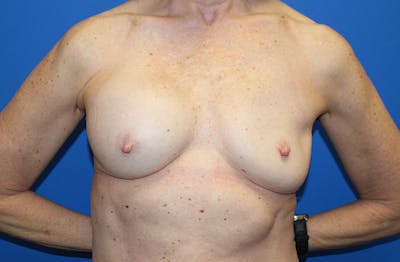 Breast Implant Removal Before & After Gallery - Patient 263851 - Image 1