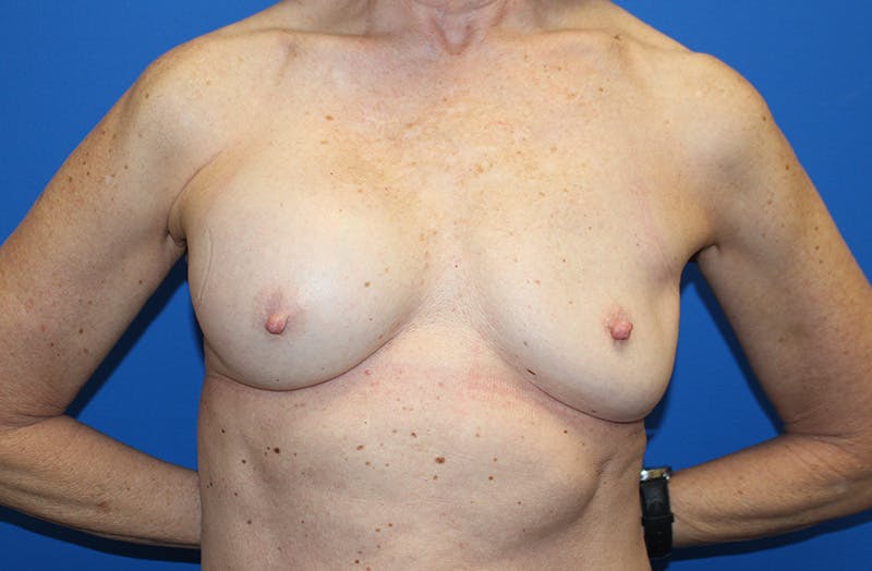 Breast Implant Removal Before & After Gallery - Patient 263851 - Image 1
