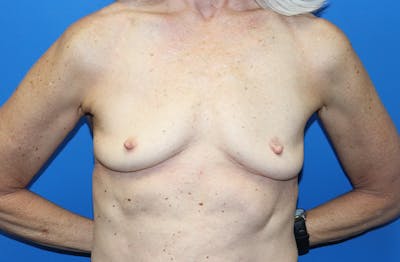 Breast Implant Removal Before & After Gallery - Patient 263851 - Image 2