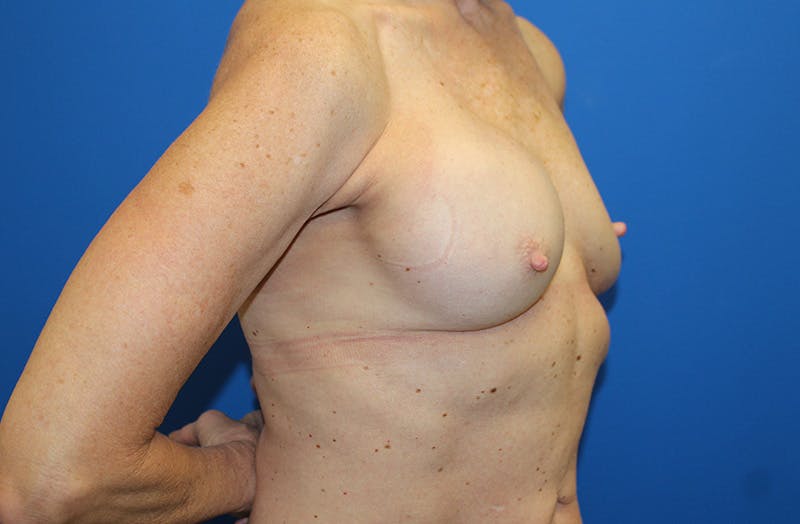 Breast Implant Removal Before & After Gallery - Patient 263851 - Image 3