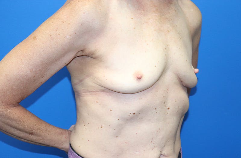 Breast Implant Removal Before & After Gallery - Patient 263851 - Image 4