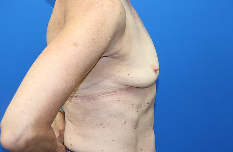 Breast Implant Removal Before & After Gallery - Patient 263851 - Image 6