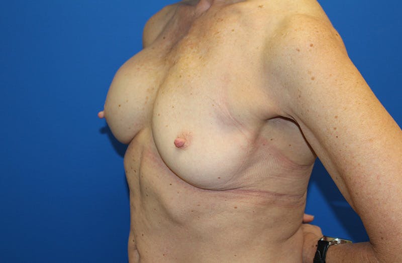 Breast Implant Removal Before & After Gallery - Patient 263851 - Image 7