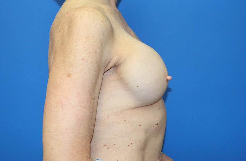 Breast Implant Removal Before & After Gallery - Patient 263851 - Image 5