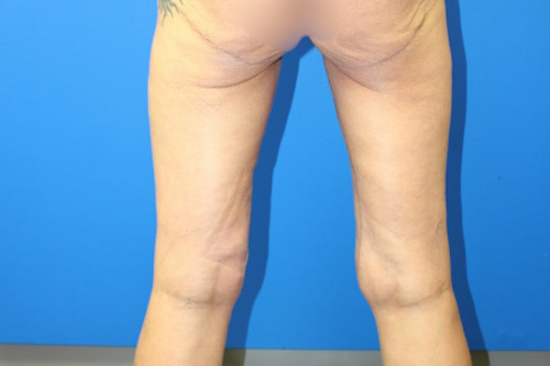 Thigh Lift Before & After Gallery - Patient 380357 - Image 6