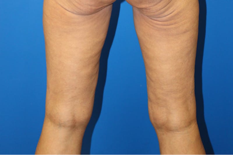 Thigh Lift Before & After Gallery - Patient 380357 - Image 5
