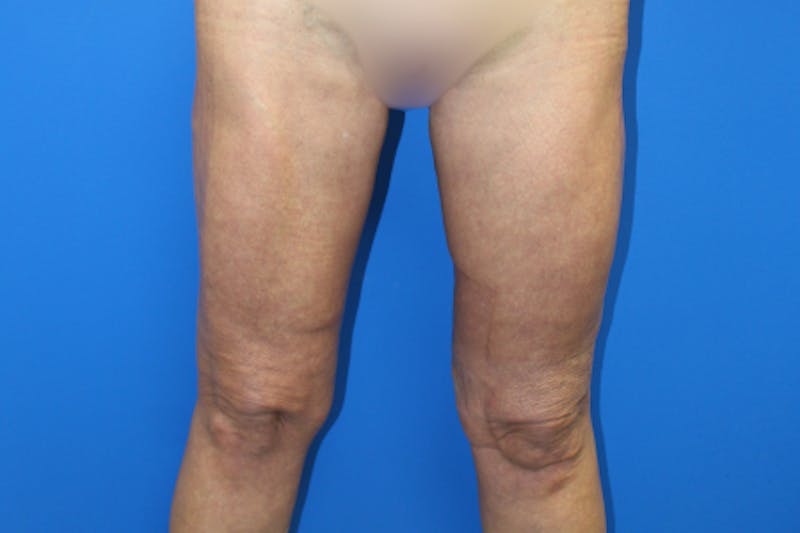 Thigh Lift Before & After Gallery - Patient 380357 - Image 2