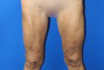 Thigh Lift Before & After Gallery - Patient 380357 - Image 1