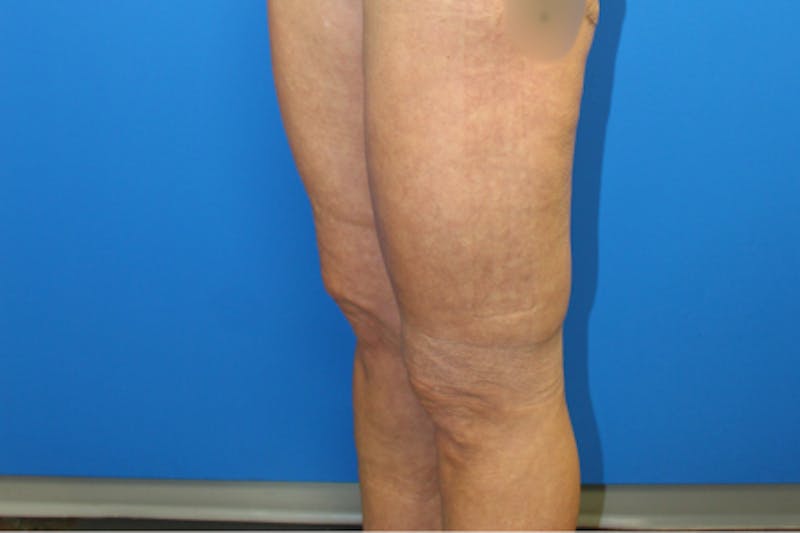 Thigh Lift Before & After Gallery - Patient 380357 - Image 4