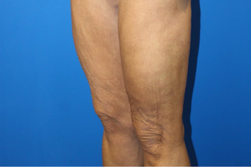 Thigh Lift Before & After Gallery - Patient 380357 - Image 3