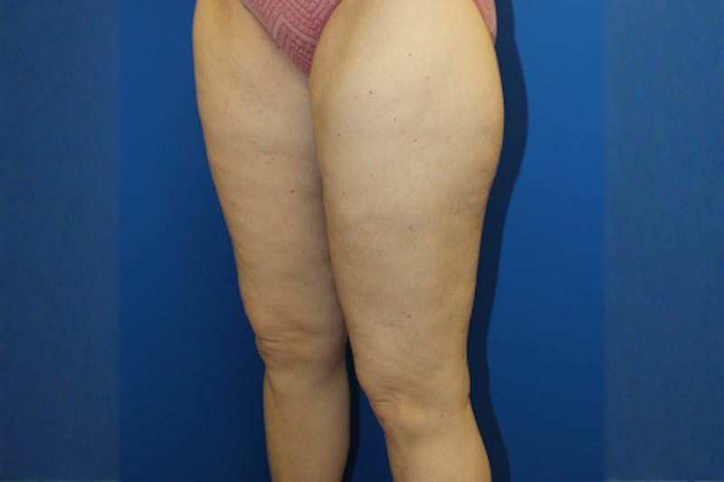 Thigh Lift Before & After Gallery - Patient 849709 - Image 4