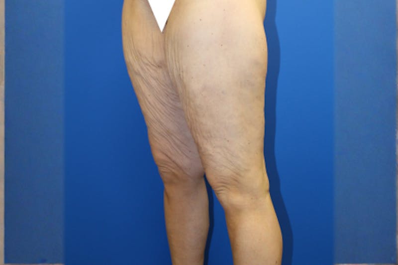 Thigh Lift Before & After Gallery - Patient 849709 - Image 3