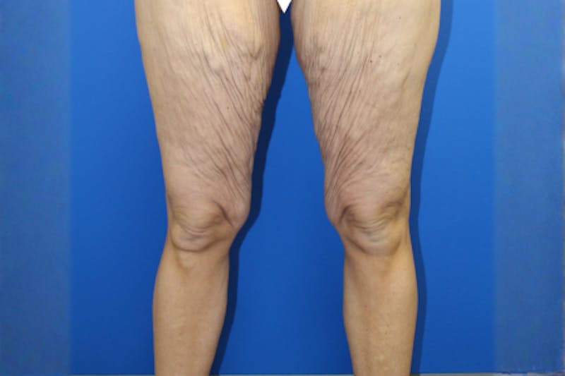 Thigh Lift Before & After Gallery - Patient 849709 - Image 1