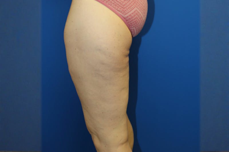 Thigh Lift Before & After Gallery - Patient 849709 - Image 6