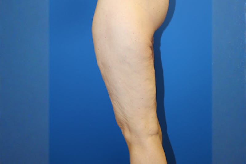 Thigh Lift Before & After Gallery - Patient 849709 - Image 5