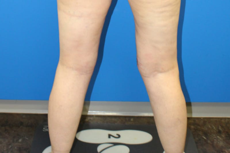 Thigh Lift Before & After Gallery - Patient 939964 - Image 4