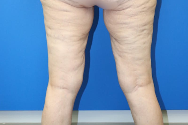 Thigh Lift Before & After Gallery - Patient 939964 - Image 3