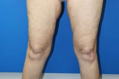 Thigh Lift Before & After Gallery - Patient 939964 - Image 1