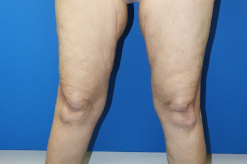 Thigh Lift Before & After Gallery - Patient 939964 - Image 1