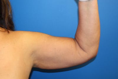 Liposuction Before & After Gallery - Patient 622173 - Image 2