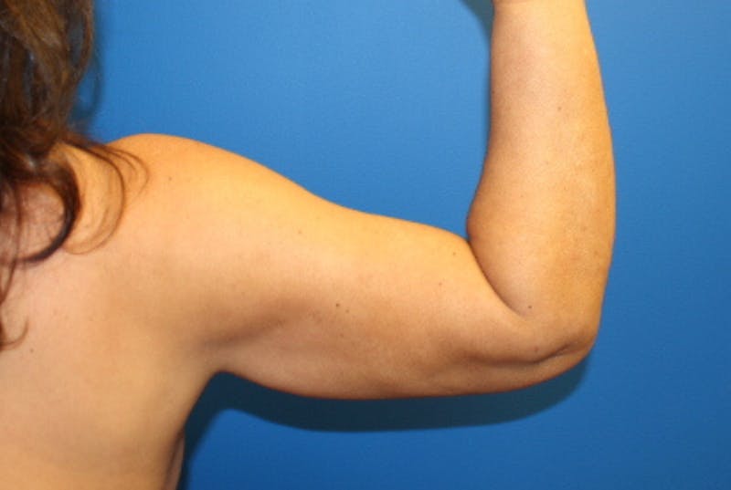 Liposuction Before & After Gallery - Patient 622173 - Image 4