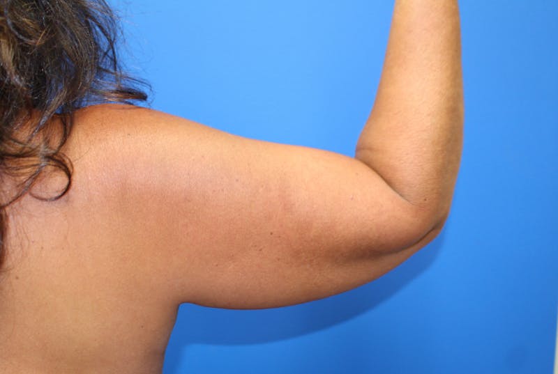 Liposuction Before & After Gallery - Patient 622173 - Image 3