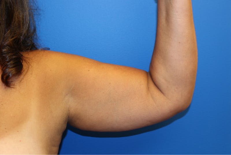 Liposuction Before & After Gallery - Patient 622173 - Image 1