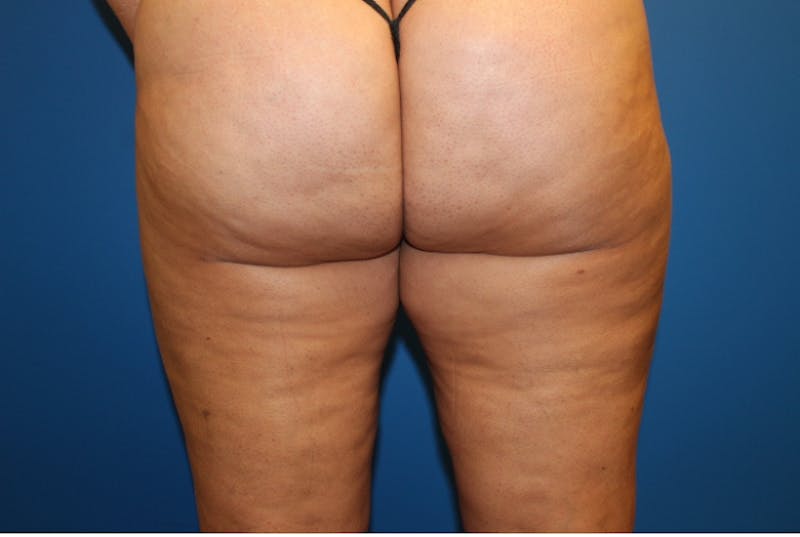 Liposuction Before & After Gallery - Patient 126926 - Image 4