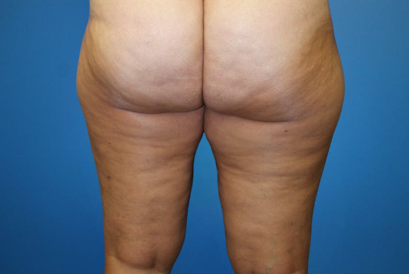 Liposuction Before & After Gallery - Patient 126926 - Image 3
